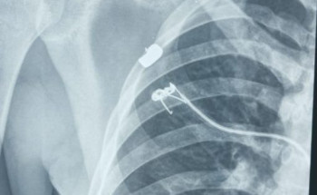 فريق طبي ينجح في تثبيت الترقوة جراحيا في مستشفى القويعية العام