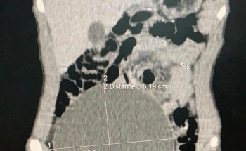 إنهاء معاناة مريض من تورم في الجانب الأيمن للبطن بمستشفى عفيف العام
