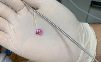 إنقاذ طفل يعاني من وجود جسم غريب داخل انفه بمستشفى الاسياح العام