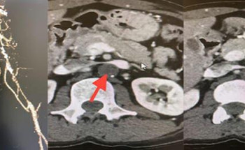 جراحة ناجحة لأربعيني بالخبر كاد أن يفقد الحركة