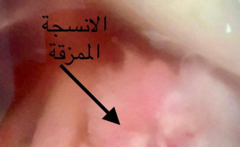 بالتعاون بين جامعة الجوف وصحة الجوف: نجاح عملية نوعية لإصلاح وتثبيت أنسجة متمزقة في كتف مريض