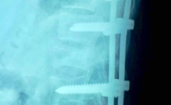 إنقاذ شاب سعودي من شلل مؤكد نتيجة حادث مروع بمستشفى طبرجل بالجوف