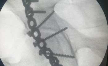 تدخل طبي ناجح في مستشفى القويعية مع حالة مصاب في حادث مروري