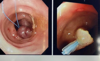 نجاح استئصال ورم من مريض خمسيني باستخدام المنظار خلال ٣٠ دقيقة