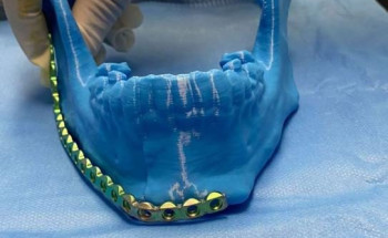 إعادة بناء فك مريض بتبوك