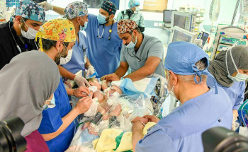 بدء عملية فصل التوأم السيامي العراقي “على وعمر