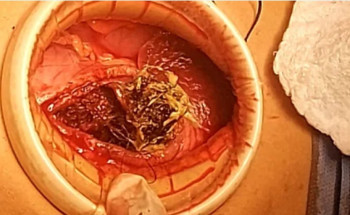 في عملية نادرة..استخراج كتلة شعر كبيرة من معدة امرأة في مستشفى الملك عبدالعزيز بمكة