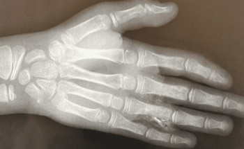 جراحة طارئة تنقذ طفلًا تعرّض لحادث مروري في الحريق