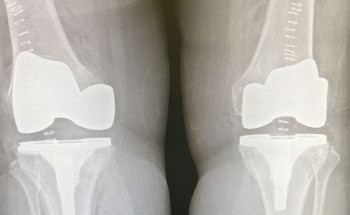 4 ساعات جراحية لتمكين مريضة للمشي في بريدة