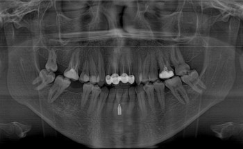 جراحة ٣٠ دقيقة تنهي معاناة مريض دامت ١٣ عام
