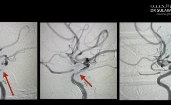 مستشفى الدكتور سليمان الحبيب بالخبر يعيد أربعينيًّا لحياته الطبيعية بعد انسداد الشريان السباتي الدماغي