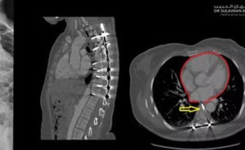 مستشفى سليمان الحبيب بالريان ينقذ ثلاثينية من مضاعفات جراحة سابقة بالعمود الفقري
