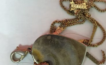 استقرت بالمريء.. تدخل طبي طارئ بالمدينة ينقذ حياة طفلة ابتلعت “قلادة”!