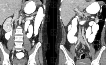 مستشفى سليمان الحبيب بالخُبر ينجح في استئصال ورم بطني وزنه 3 كجم