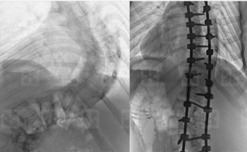 مستشفى سليمان الحبيب بالقصيم: فريق طبي يُجري 4 عمليات تعديل جنف ناجحة خلال 48 ساعة