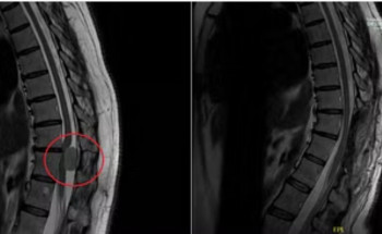 مركز جراحات المخ والأعصاب والعمود الفقري بمجمع الدكتور سليمان الحبيب بالعُليا يُعيد قدرة خمسينية على المشي مجدّداً