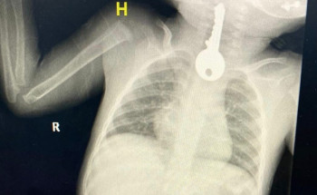 تدخل عاجل لاستخراج مفتاح من مريء طفل