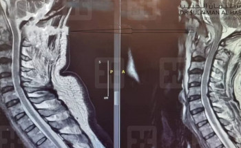 جراحة نادرة ومعقدة بمستشفى سليمان الحبيب بالقصيم تعيد الحركة لستيني عانى من شلل نصفي