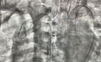 مستشفى الدكتور سليمان الحبيب بالتخصُّصي ينهي معاناة تسعيني مع تضيق في الصمام الأبهر