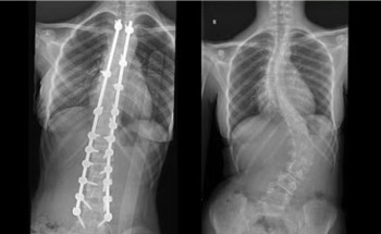 جراحة ناجحة “لفتاة” بمجمع الدكتور سليمان الحبيب بالعليا لتصحيح تقوّسات حادّة بالفقرات القطنية والصدرية وعظام الحوض