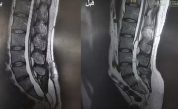 إنهاء معاناة شاب مع عيب خلقي وورم كبير مخترق للقناة الشوكية