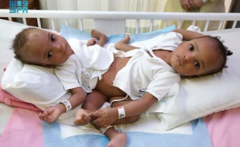 إنفاذًا لتوجيهات خادم الحرمين الشريفين .. بدء عملية فصل التوأم السيامي النيجيري”حسانة وحسينة”