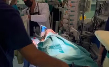 انتهاء عملية فصل السيامي السوري “بسام وإحسان”