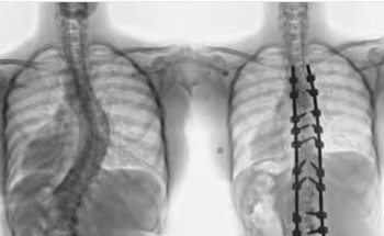 مستشفى الدكتور سليمان الحبيب بالقصيم ينهي معاناة “قطرية” مع انحراف بالعمود الفقري بجراحة معقدة