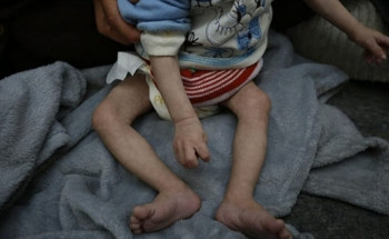 بينهم طفلان.. وفاة 4 فلسطينيين بسبب الجوع بمستشفى كمال عدوان في بيت لاهيا شمال غزة