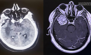 مستشفى الدكتور سليمان الحبيب بالخبر يستأصل ورماً دماغياً سبب فقدان الوعي وتشنجات حادة لخمسيني