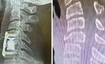 فريق طبي ينقذ شاباً سقط من ارتفاع 6 أمتار بالطائف