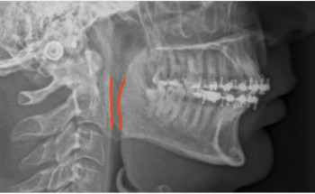 “سعود الطبية” تنهي جراحيًّا معاناة أربعيني من اضطراب النوم