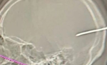 بطول 8 سم.. استخراج “مسمار” من جمجمة مقيم آسيوي بـ”ينبع العام”