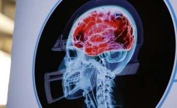 “دراسة”.. إصابات الرأس توقظ فيروسات الزهايمر