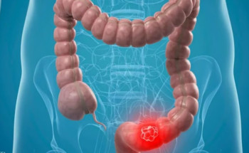 دراسة: تضاعُف حالات سرطان القولون بين الشباب عالميًّا بسبب الكحول والسمنة ونقص الكالسيوم