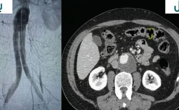 نجاح عملية إصلاح تمدد الشريان الأورطي البطني لمريض يبلغ من العمر 69 عامًا في مستشفيات المانع بالخبر