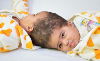 نجاح عملية فصل التوأم الملتصق الإريتري “أسماء وسمية” بعد عملية جراحية دقيقة استغرقت 15 ساعة ونصفًا
