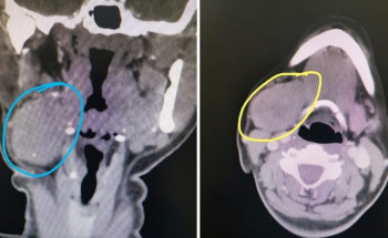 استغرقت ساعتين.. نجاح عملية دقيقة لاستئصال ورم من الغدة تحت الفك السفلي بمجمع الملك فيصل الطبي
