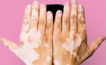 اليوم العالمي للبهاق.. توعية بالمرض وتفعيل الاستشارات الطبية وإمكانات العلاج