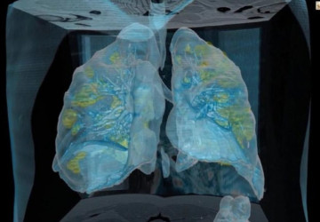 فيديو يكشف تلف رئة مريض مصاب بفايرس كورونا