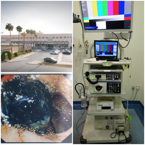 إنهاء معاناة مريضة من إنسداد في القناة الصفراوية