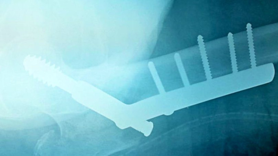 نجاح علاج كسر مفتت لمريضة تسعينية