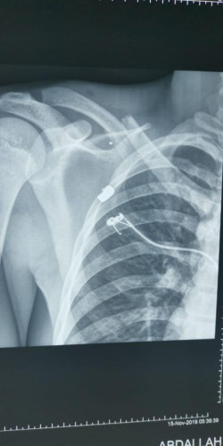 فريق طبي ينجح في تثبيت الترقوة جراحيا في مستشفى القويعية العام