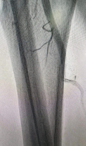 قسطرة ناجحة لشرايين الأطراف السفلية لمريض بالقريات