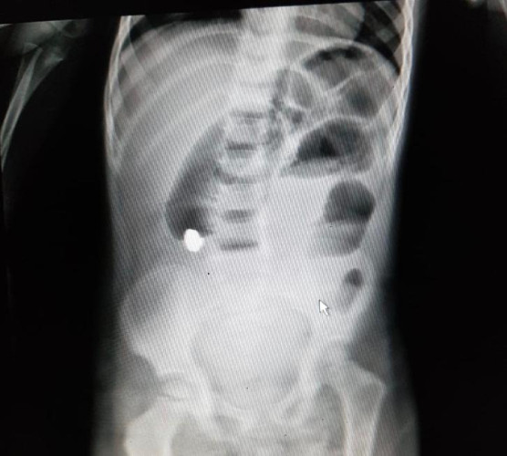 نجاح إزاله جسم معدني من أمعاء طفل بحفر الباطن