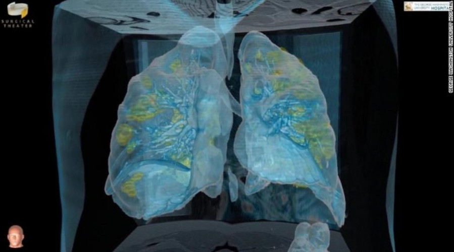 فيديو يكشف تلف رئة مريض مصاب بفايرس كورونا