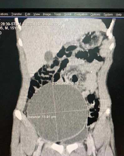 إنهاء معاناة مريض من تورم في الجانب الأيمن للبطن بمستشفى عفيف العام