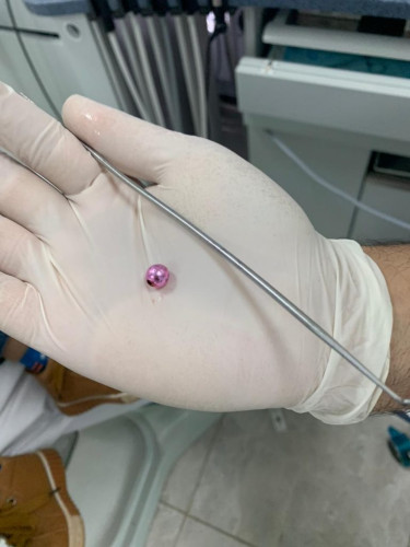 إنقاذ طفل يعاني من وجود جسم غريب داخل انفه بمستشفى الاسياح العام