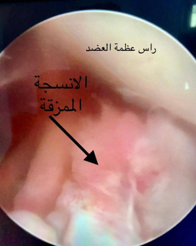 بالتعاون بين جامعة الجوف وصحة الجوف: نجاح عملية نوعية لإصلاح وتثبيت أنسجة متمزقة في كتف مريض