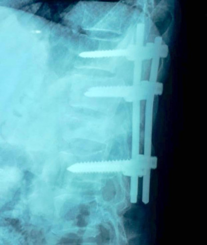 إنقاذ شاب سعودي من شلل مؤكد نتيجة حادث مروع بمستشفى طبرجل بالجوف